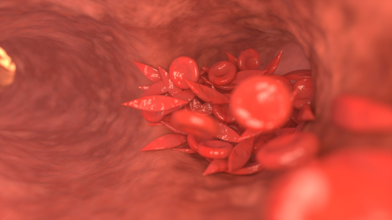 Sickle Cell Vaso-Occlusion