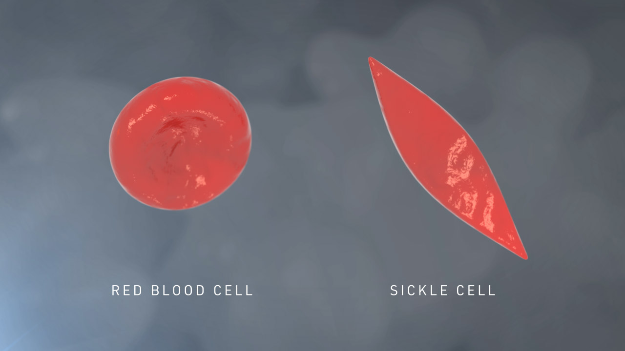 Red Blood Cell vs Sickle Cell Loop Grey