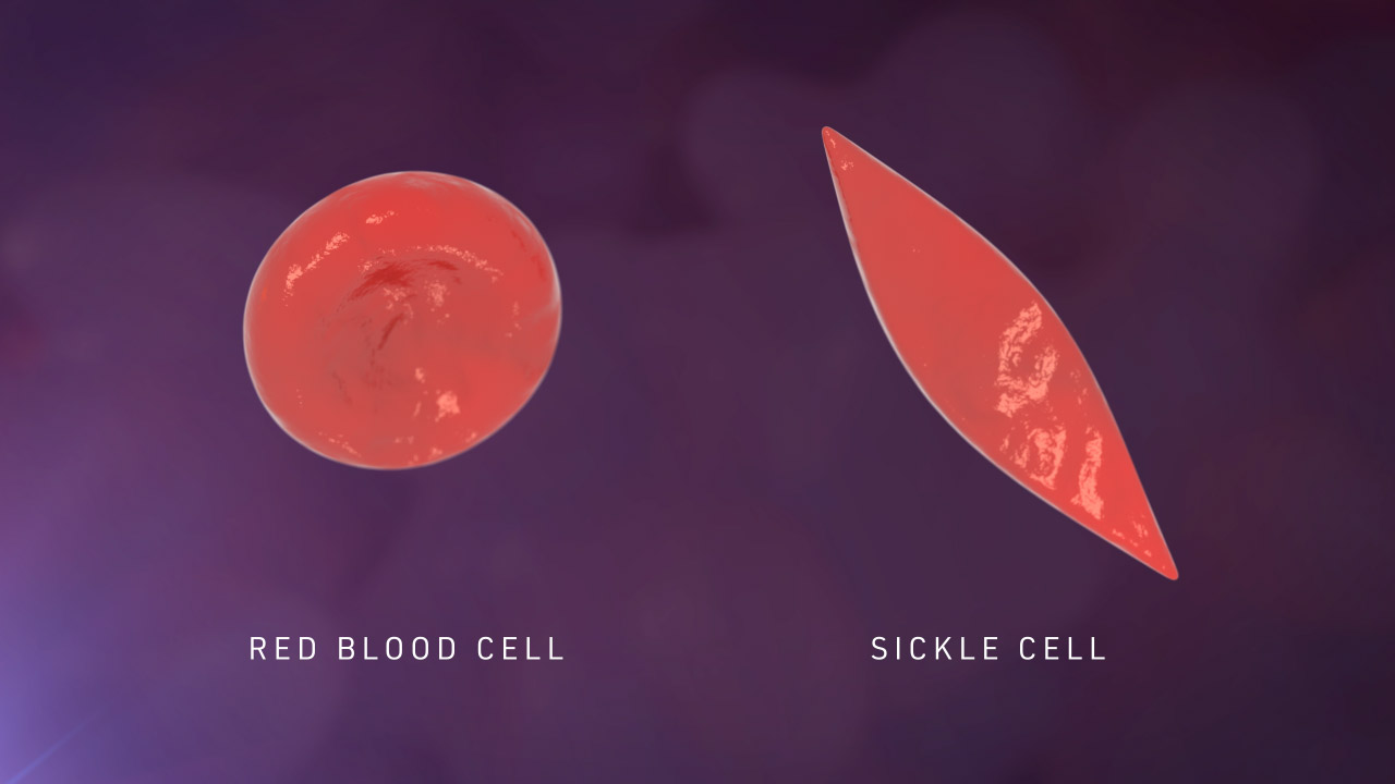 Red Blood Cell vs Sickle Cell Loop Maroon