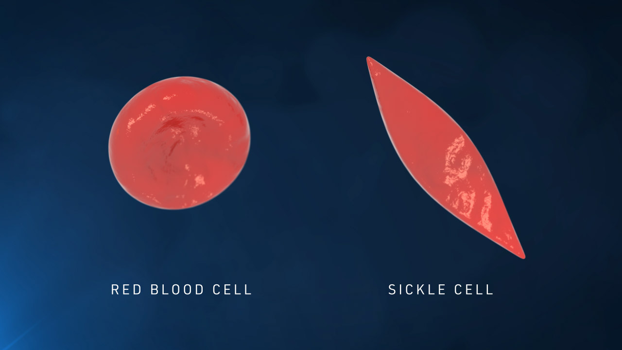 Red Blood Cell vs Sickle Cell