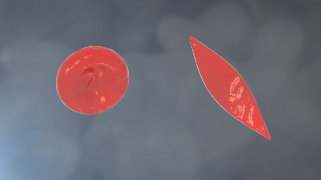 Red Blood Cell vs Sickle Cell No Labels Grey